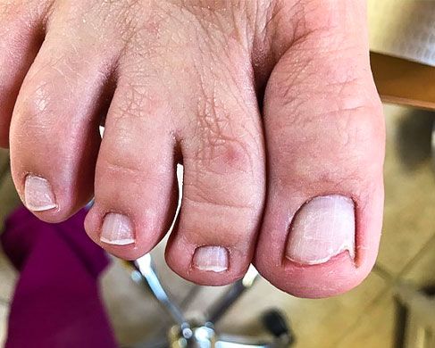 Foot Treatment After 8