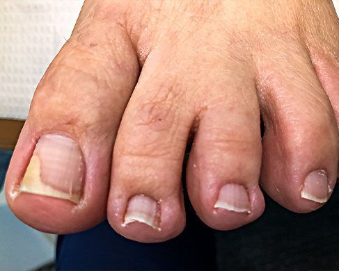 Foot Treatment Before 7