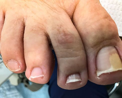 Foot Treatment Before 8