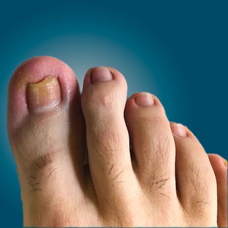 Foot Treatment After 1