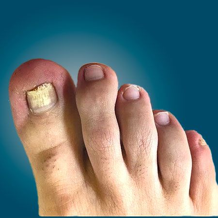 Foot Treatment Before 1