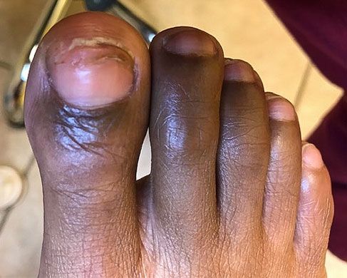 Foot Treatment After 5