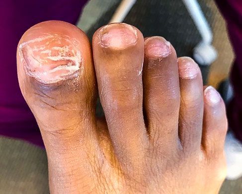 Foot Treatment Before 5