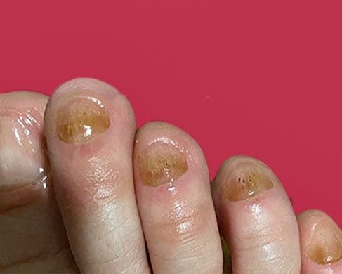 Foot Treatment Before 6