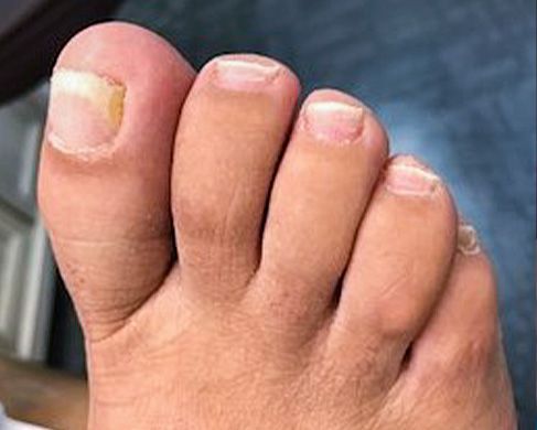 Foot Treatment After 4