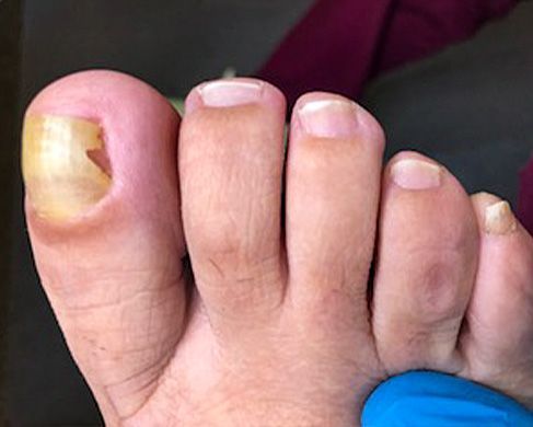 Foot Treatment Before 4