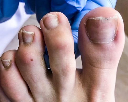 Foot Treatment After 2