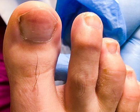 Foot Treatment After 3