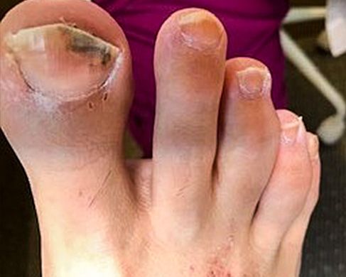 Foot Treatment Before 3