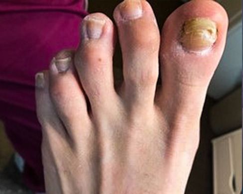 Foot Treatment Before 2