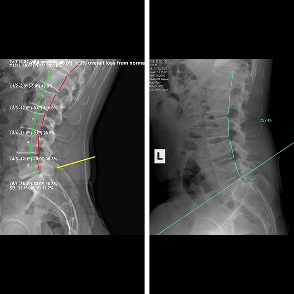 A couple of x-rays of a person 's spine.