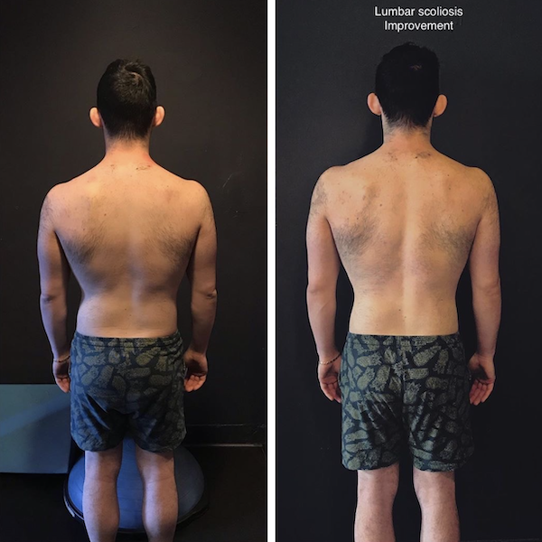 A before and after picture of a man with lumbar scoliosis