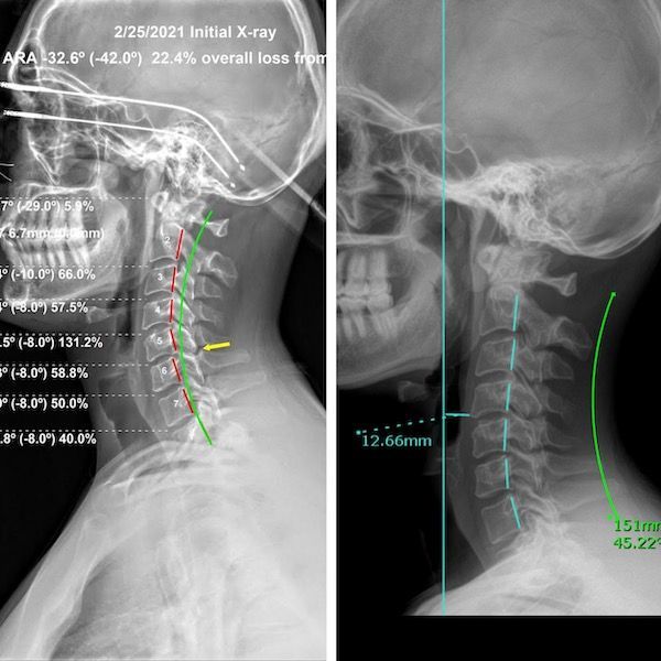 Two x-rays of a person 's head and neck