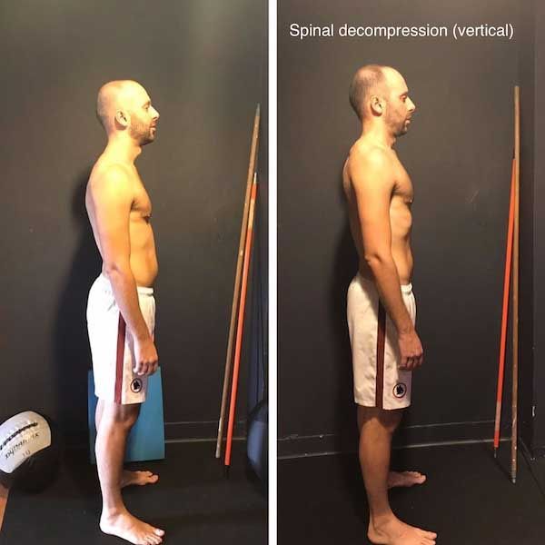 Two pictures of a man with spinal decompression