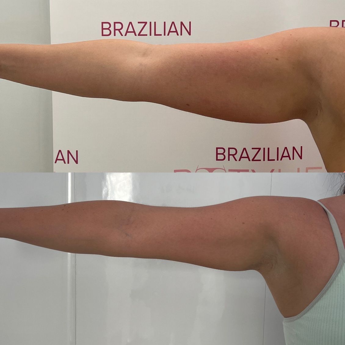 A before and after photo of a woman 's arm with the words brazilian on the wall behind her