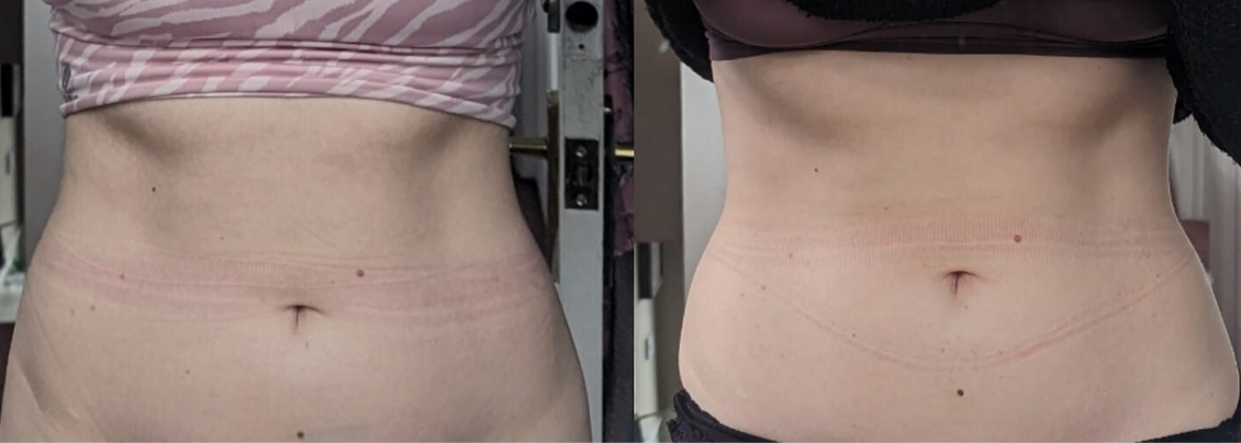 A before and after picture of a woman 's stomach.