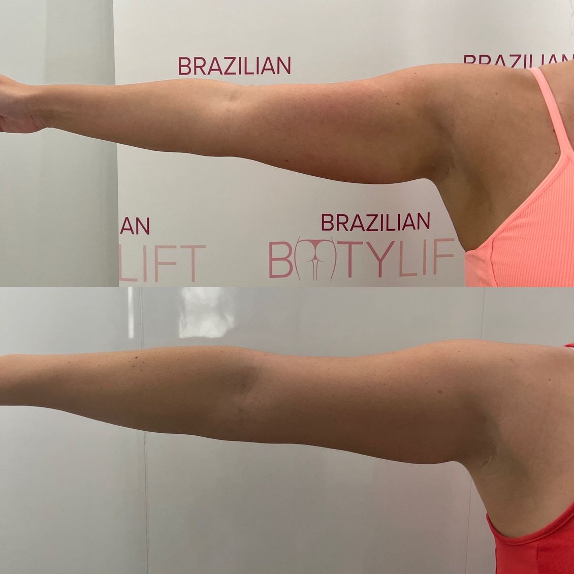 A woman 's arm is shown before and after brazilian buttlift