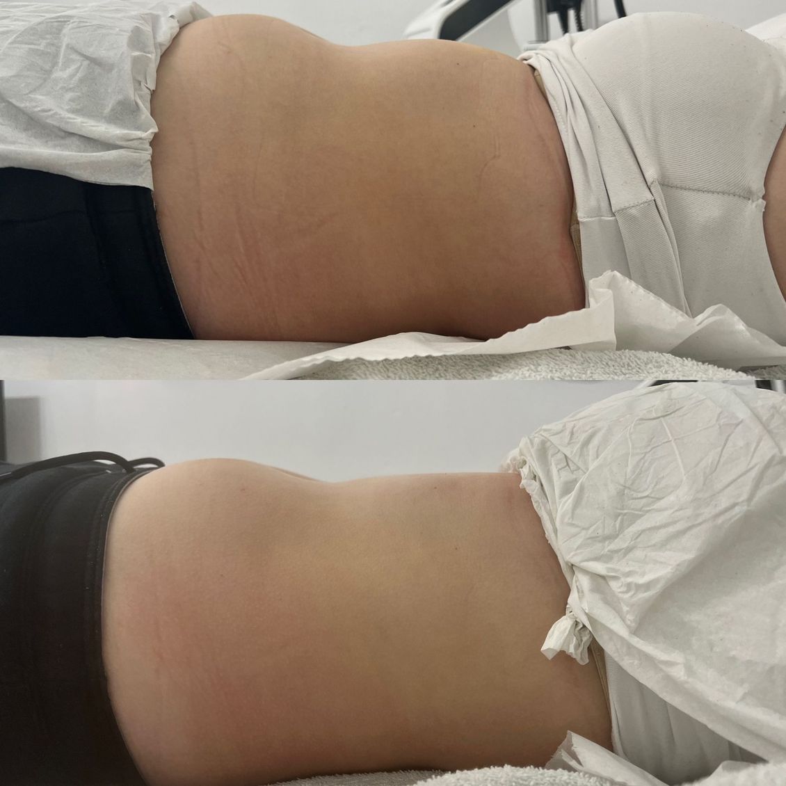 A before and after picture of a woman 's stomach.