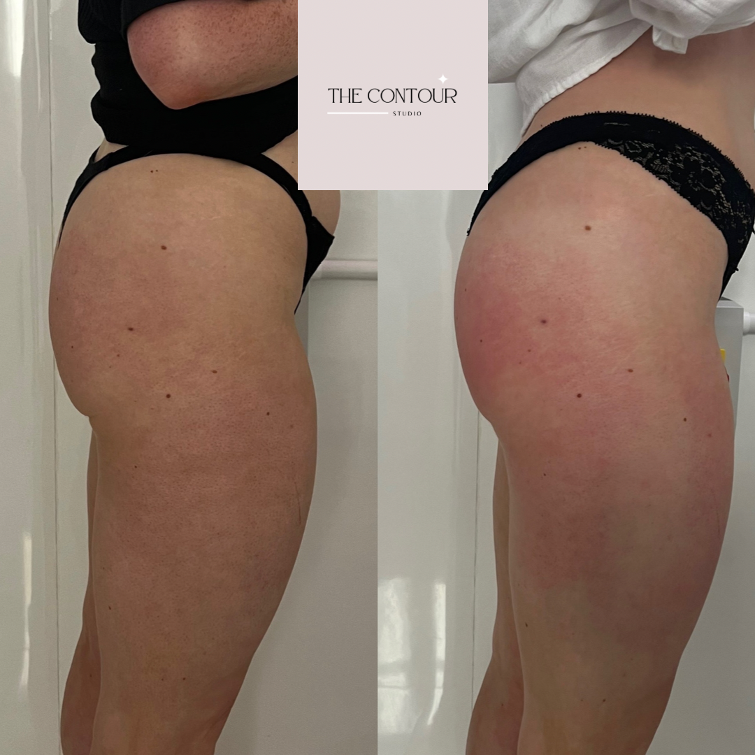 Before and after from treatment of the bum