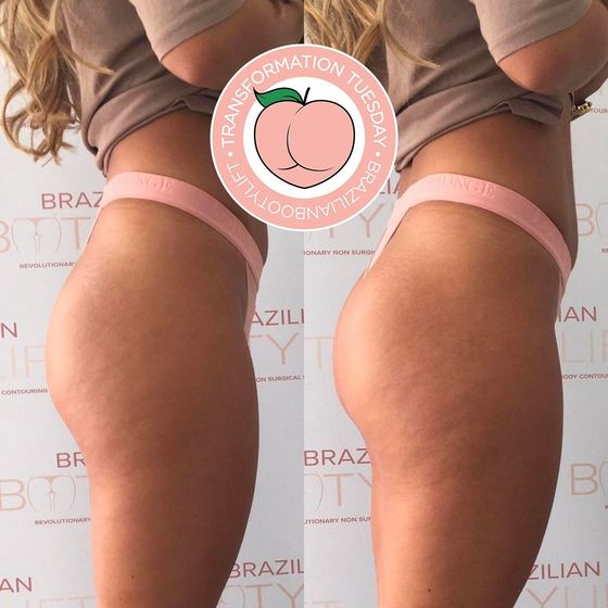 Before and after from treatment of the bum