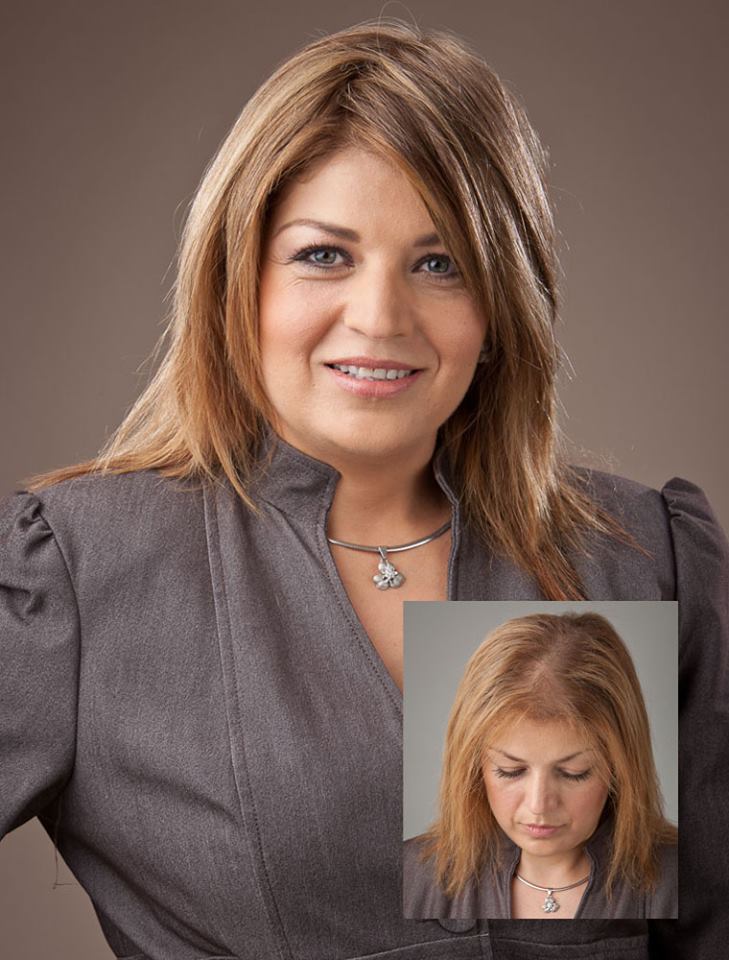 woman showing the before and after images of hair restoration