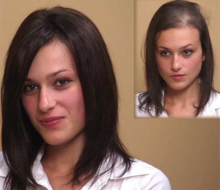 woman showing the before and after images of hair restoration