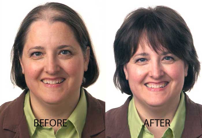 woman showing the before and after images of hair restoration