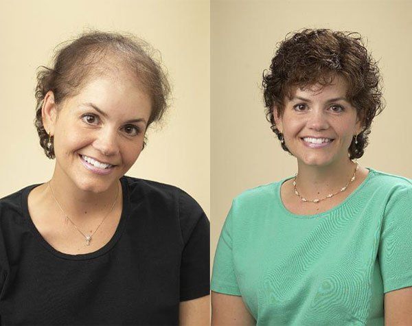 woman showing the before and after images of hair restoration