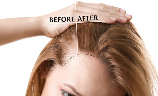 before and after view of woman hair restoration