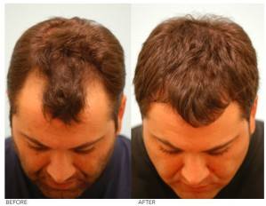 male hair restoration to fix receding hairline