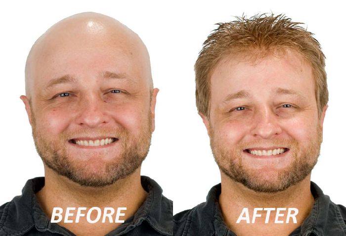 male hair restoration to fix balding