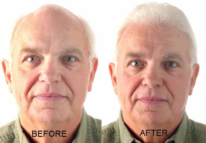 male hair restoration to fix balding