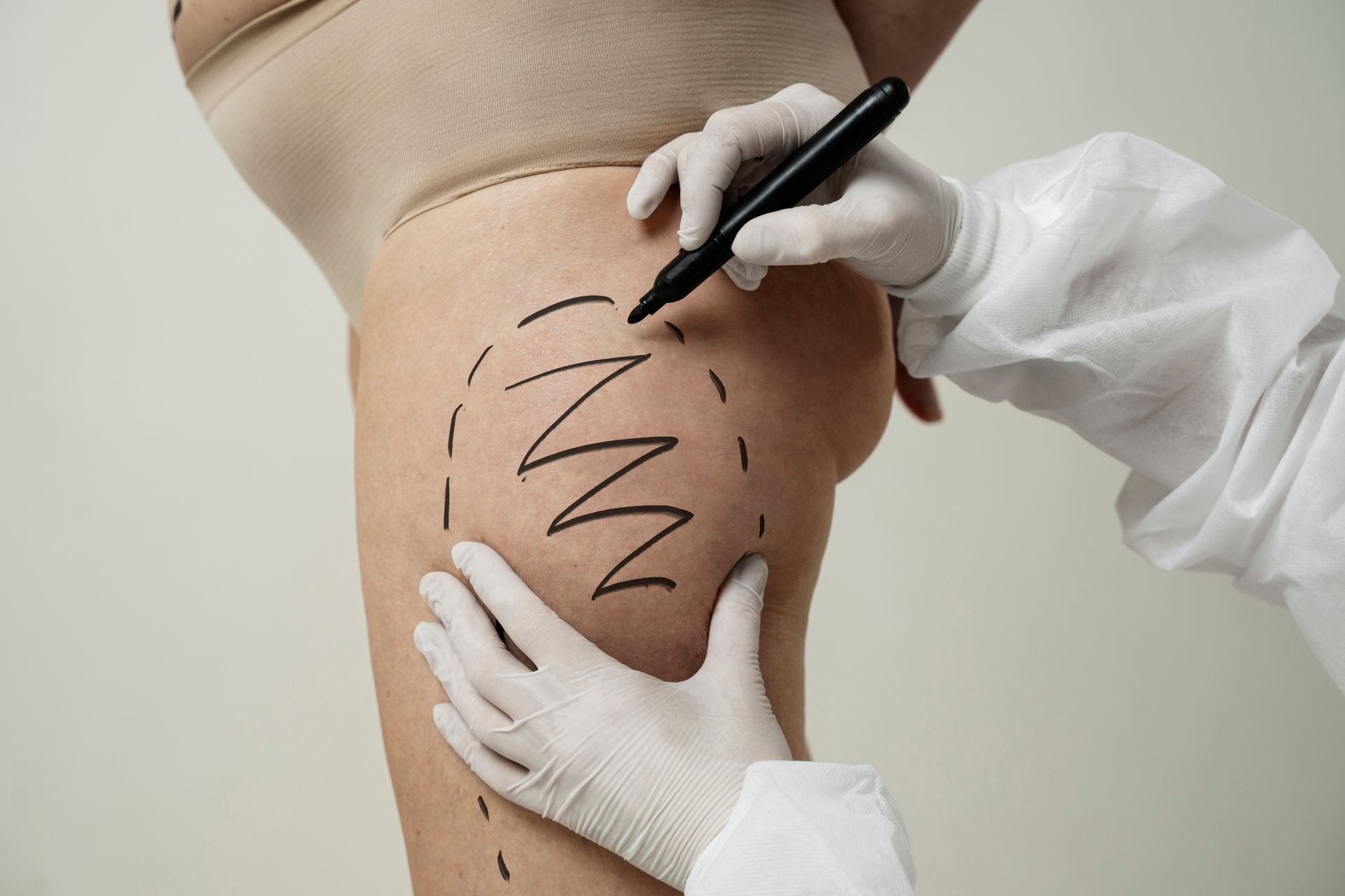 A person is drawing lines on a woman's leg with a marker.