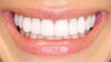 Top Smile Makeover Studio | Simply Veneers