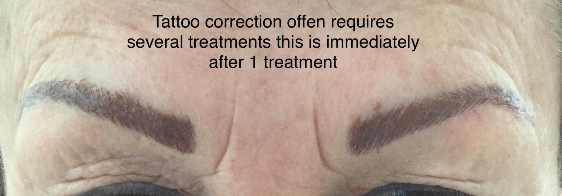 Eyebrow Tattoo Correction On Client - Treatment 1 — Cosmetic Tattooing in Bundaberg, QLD