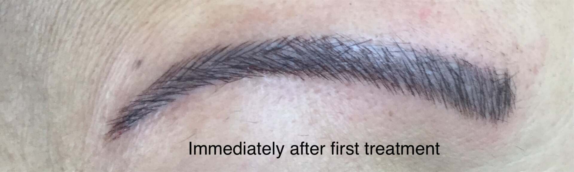 After Scar Correction On Old Tattoo — Cosmetic Tattooing in Bundaberg, QLD