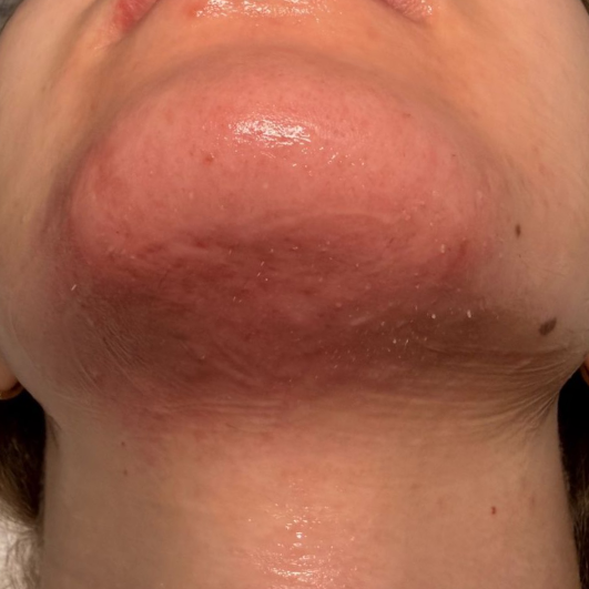 Nadelepilation Elektroepilation Berlin