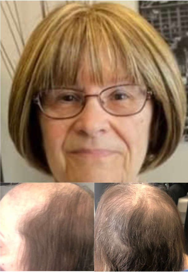 Man with thinning hair looks distressed at his reflection in a red hand mirror.