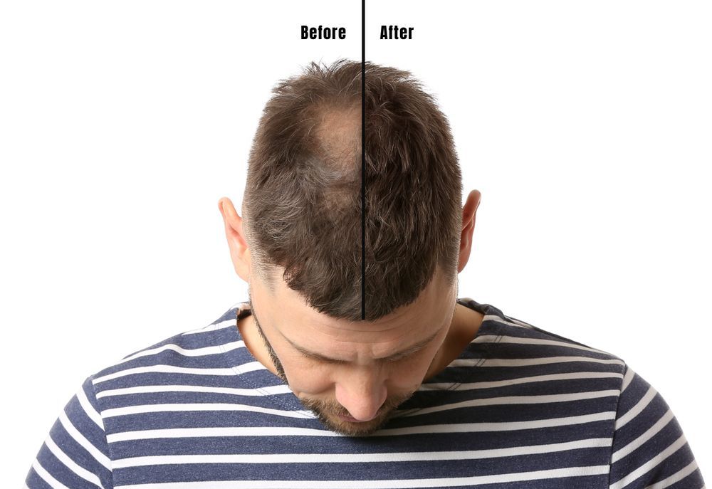 Man's head showing hair loss before and after treatment; bald patch regrown.