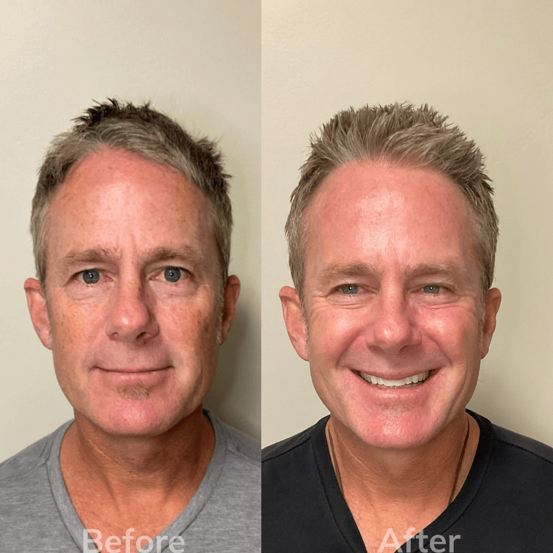 Male Laser Facial Resurfacing