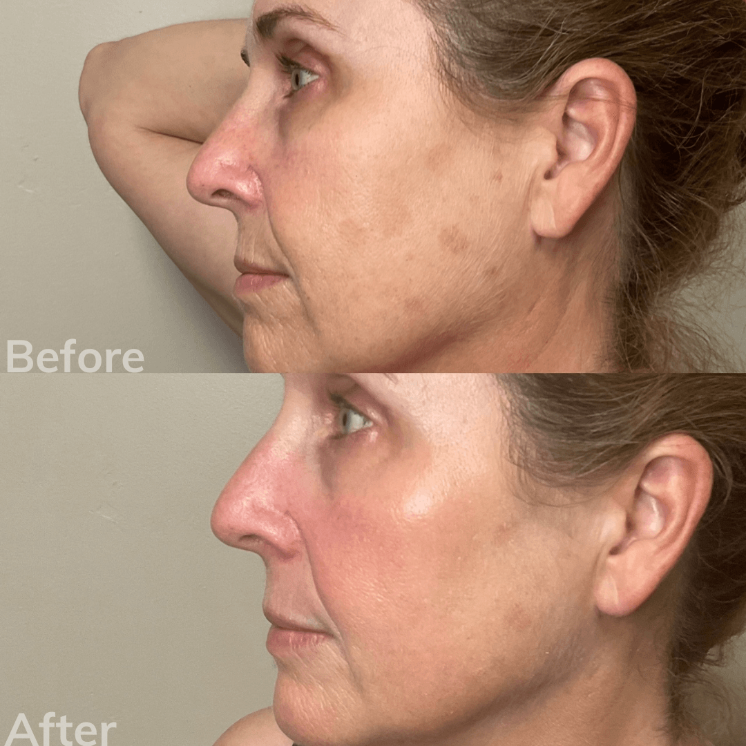 Female Laser Facial Resurfacing San Marcos