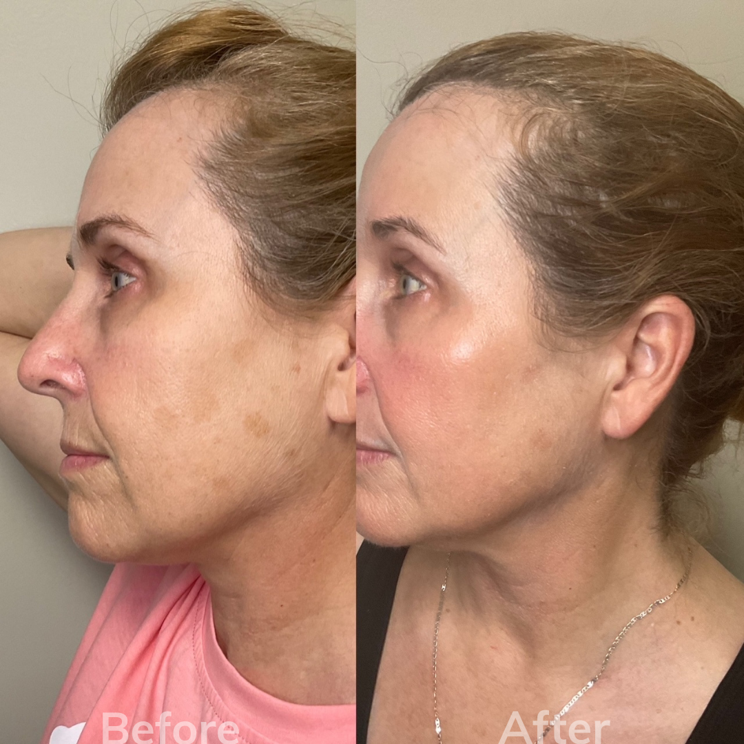 Female Laser Facial Rejuvenation
