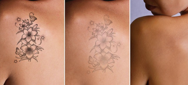 Laser Tattoo Removal In Chorley - Safe & Effective Tattoo Removal