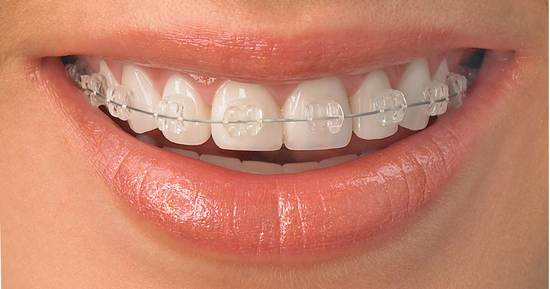 Brackets de Cristal zafiro transparentes que no se manchan ni cambian de color, resistentes y estéticos.