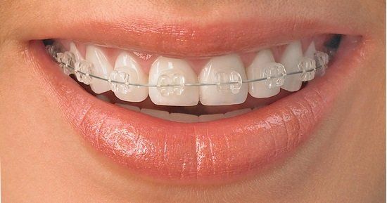 Brackets de Cristal zafiro transparentes que no se manchan ni cambian de color, resistentes y estéticos.