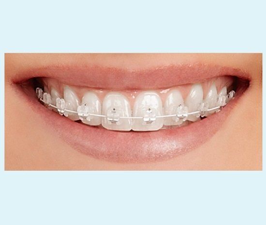 Brackets de autoligado transparentes, brackets inteligentes con alta tecnología