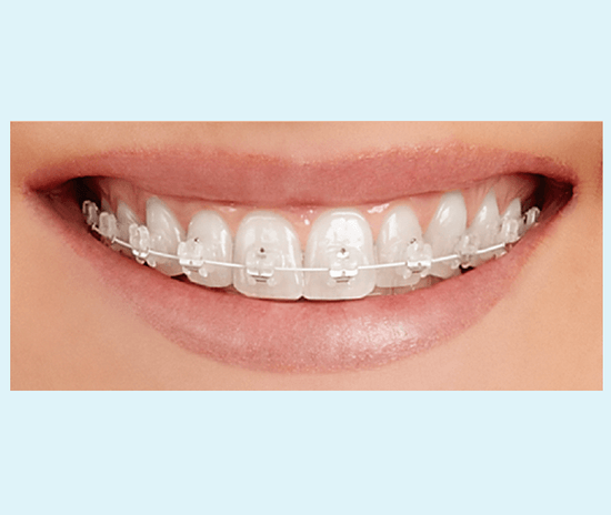 Ortodoncia brackets autoligado transparentes