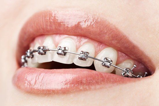 Brackets metálicos con alta tecnología para movimientos rápidos.