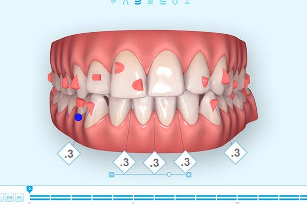 Clincheck invisalign doctor