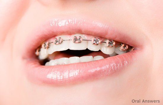 Brackets Metálicos Convencionales, usa los elásticos del color que quieras